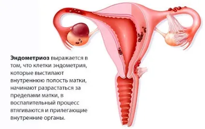 Аденоміоз матки - що це таке симптоми і лікування при вагітності (матки) Аденоміоз матки - що це таке симптоми і лікування при вагітності