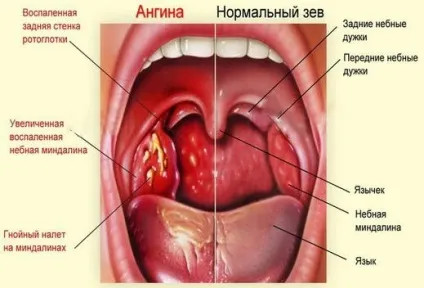 Ангіна у дорослих симптоми і лікування (ангіна) Ангіна у дорослих симптоми і лікування