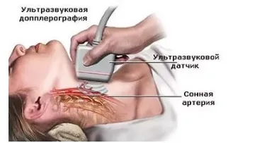Атеросклероз брахіоцефальних артерій симптоми і лікування (артерій) Атеросклероз брахіоцефальних артерій симптоми і лікування