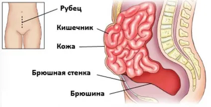 Бандаж після операції пахової грижі як вибрати (після) Бандаж після операції пахової грижі як вибрати