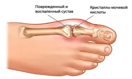 Артроз суглобів великого пальця ноги (стопи) причини, симптоми, лікування, народні засоби (великого) Артроз суглобів великого пальця ноги (стопи) причини, симптоми, лікування, народні засоби