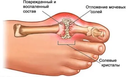 Артрит - симптоми, лікування