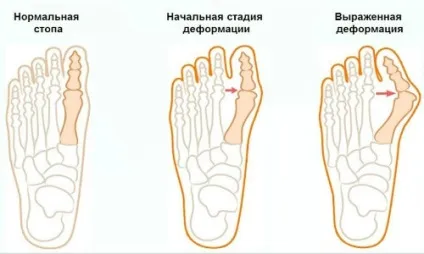 Артроз суглобів великого пальця ноги (стопи) причини, симптоми, лікування, народні засоби (стопи) Артроз суглобів великого пальця ноги (стопи) причини, симптоми, лікування, народні засоби