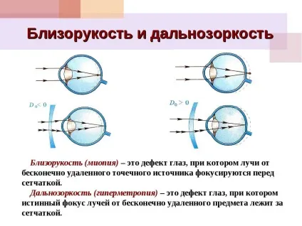Астигматизм і короткозорість основих відмінності (короткозорість) Астигматизм і короткозорість основих відмінності