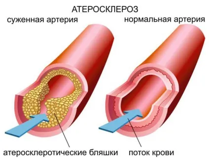 Атеросклероз БЦА (брахіоцефальних артерій) - причини, симптоми, лікування, екстракраніального відділу