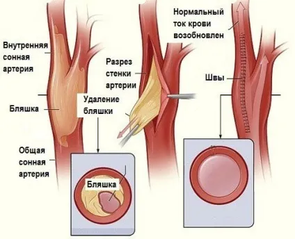 Атеросклероз брахіоцефальних артерій симптоми і лікування (артерій) Атеросклероз брахіоцефальних артерій симптоми і лікування