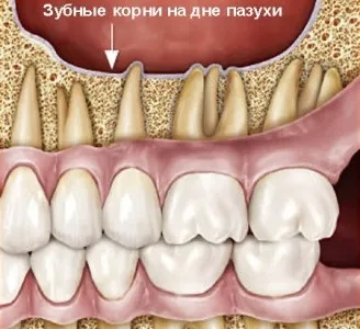 Можливі ускладнення після видалення зубів статті (видалення) Можливі ускладнення після видалення зубів статті