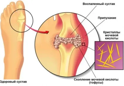 Запалення кісточки на великому пальці ноги - лікування захворювання (запалення) Запалення кісточки на великому пальці ноги - лікування захворювання