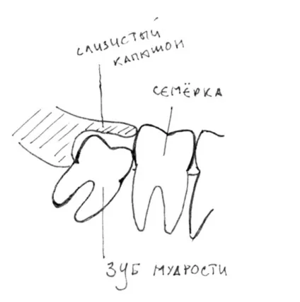 Лікар-стоматолог станислав васильев про те, навіщо треба видаляти зуби мудрості