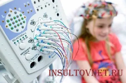 Бессудорожная епілепсія дитячі абсанси і інші види припадків (бессудорожная) Бессудорожная епілепсія дитячі абсанси і інші види припадків