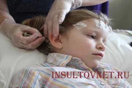 Бессудорожная епілепсія дитячі абсанси і інші види припадків (епілепсія) Бессудорожная епілепсія дитячі абсанси і інші види припадків