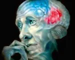 Хвороба Бінсвангера - причини, симптоми, діагностика та лікування (Бінсвангера) Хвороба Бінсвангера - причини, симптоми, діагностика та лікування