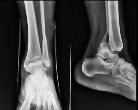 Біль в гомілкостопі причини і своєчасне лікування (зв'язки) Біль в гомілкостопі причини і своєчасне лікування