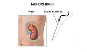 Хвороба Берже симптоматика захворювання і методи терапії