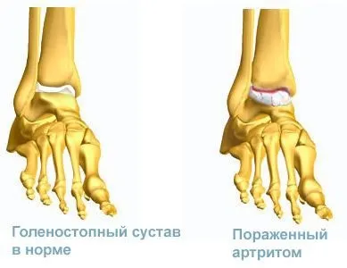 Біль в гомілкостопі причини і своєчасне лікування (гомілковостопний суглоб) Біль в гомілкостопі причини і своєчасне лікування