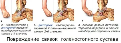 Біль в гомілкостопі причини і своєчасне лікування (біль) Біль в гомілкостопі причини і своєчасне лікування