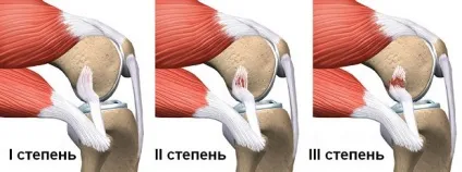 Болять коліна після бігу, велосипеда, пологів, тренування і чому у жінок