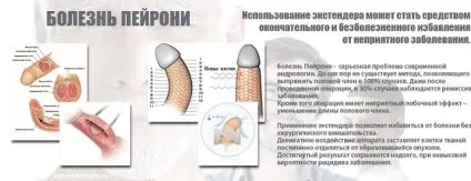 Хвороба Пейроні причини, симптоми, лікування (хвороба) Хвороба Пейроні причини, симптоми, лікування