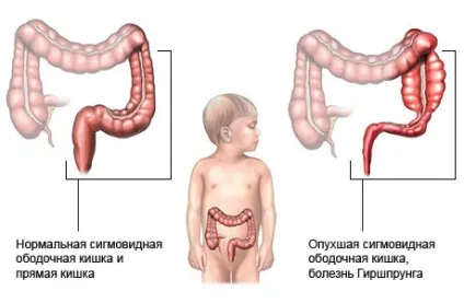 Хвороба Гіршпрунга у дітей - симптоми хвороби, профілактика і лікування хвороби Гіршпрунга у дітей, (причини хвороби Гіршпрунга у дітей) Хвороба Гіршпрунга у дітей - симптоми хвороби, профілактика і лікування хвороби Гіршпрунга у дітей,