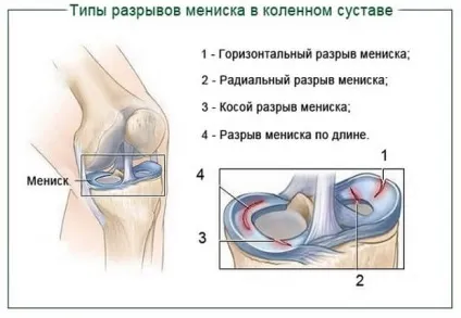 Болять коліна після бігу, велосипеда, пологів, тренування і чому у жінок