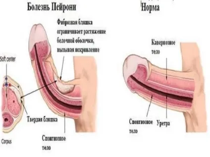 Хвороба Пейроні причини, симптоми, лікування (хвороба) Хвороба Пейроні причини, симптоми, лікування