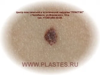 Центр пластес - видалення родимок