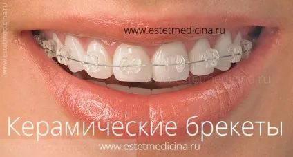 Брекет-система види, ціни