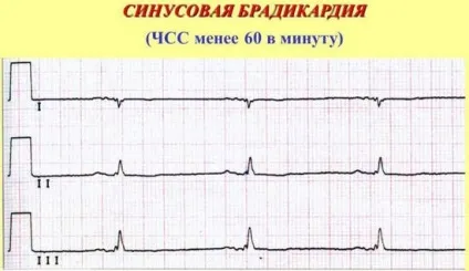 Брадикардія - причини, симптоми і лікування порушення ЧСС (брадикардія) Брадикардія - причини, симптоми і лікування порушення ЧСС