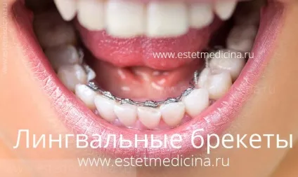 Брекет-система види, ціни