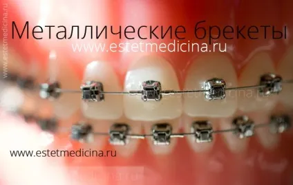 Брекет-система види, ціни