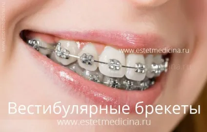 Брекет-система види, ціни