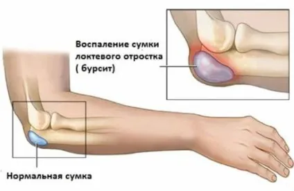 Бурсит симптоми, ознаки та діагностика при бурситах різних суглобів (симптоми) Бурсит симптоми, ознаки та діагностика при бурситах різних суглобів