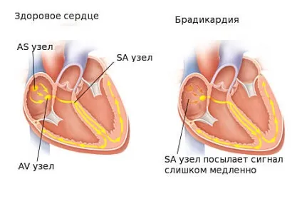 Брадикардія - причини, симптоми і лікування порушення ЧСС (лікування) Брадикардія - причини, симптоми і лікування порушення ЧСС