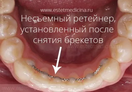 Брекет-система види, ціни