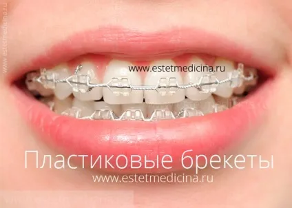 Брекет-система види, ціни