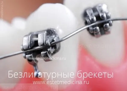 Брекет-система види, ціни
