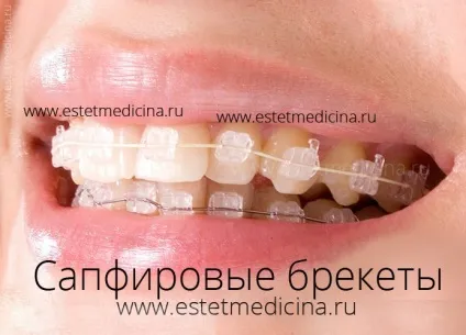 Брекет-система види, ціни