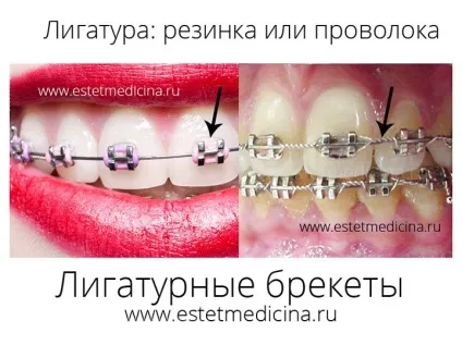 Брекет-система види, ціни
