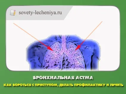 Бронхіальна астма, як боротися з нападом, робити профілактику і лікувати (робити) Бронхіальна астма, як боротися з нападом, робити профілактику і лікувати