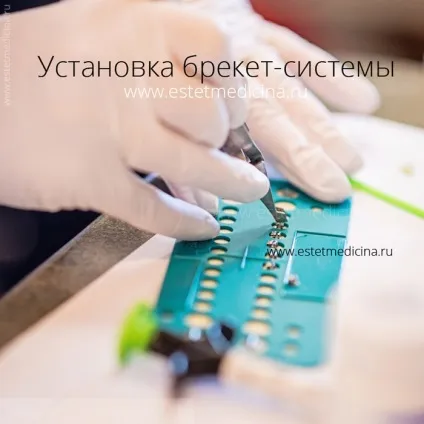 Брекет-система види, ціни