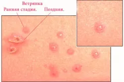 Чим мазати вітрянку крім зеленки