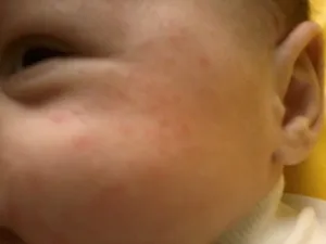 Чим лікувати і мазати алергію у дитини на зеленку і по яких симптомах її розпізнати