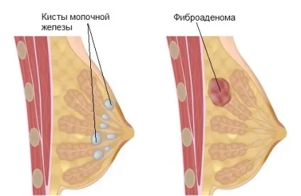 Чим небезпечна мастопатія і чому не варто відкладати її лікування (лікування) Чим небезпечна мастопатія і чому не варто відкладати її лікування