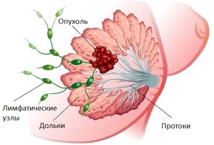 Чим небезпечна мастопатія і чому не варто відкладати її лікування (мастопатія) Чим небезпечна мастопатія і чому не варто відкладати її лікування