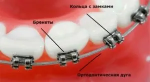 Що робити якщо відклеївся брекет (відклеївся) Що робити якщо відклеївся брекет