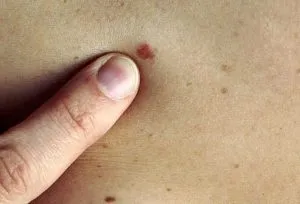 Що являє собою меланома шкіри діагностика та лікування (діагностика) Що являє собою меланома шкіри діагностика та лікування