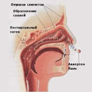 Що таке нежить чому з'являється, це хвороба чи ні (з'являється) Що таке нежить чому з'являється, це хвороба чи ні