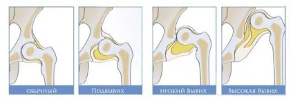 Що таке дисплазія кульшового суглоба (korpelere qulluq) Що таке дисплазія кульшового суглоба