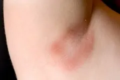Cипь під пахвами