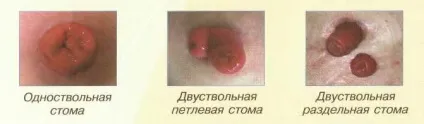 Що таке стома